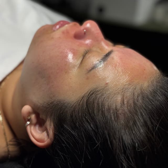 Skin Barrier Reset Peel at Fidelis Skin Theory in Las Vegas, NV