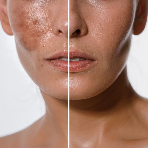 Clarity Peel Series at Fidelis Skin Theory in Las Vegas, NV